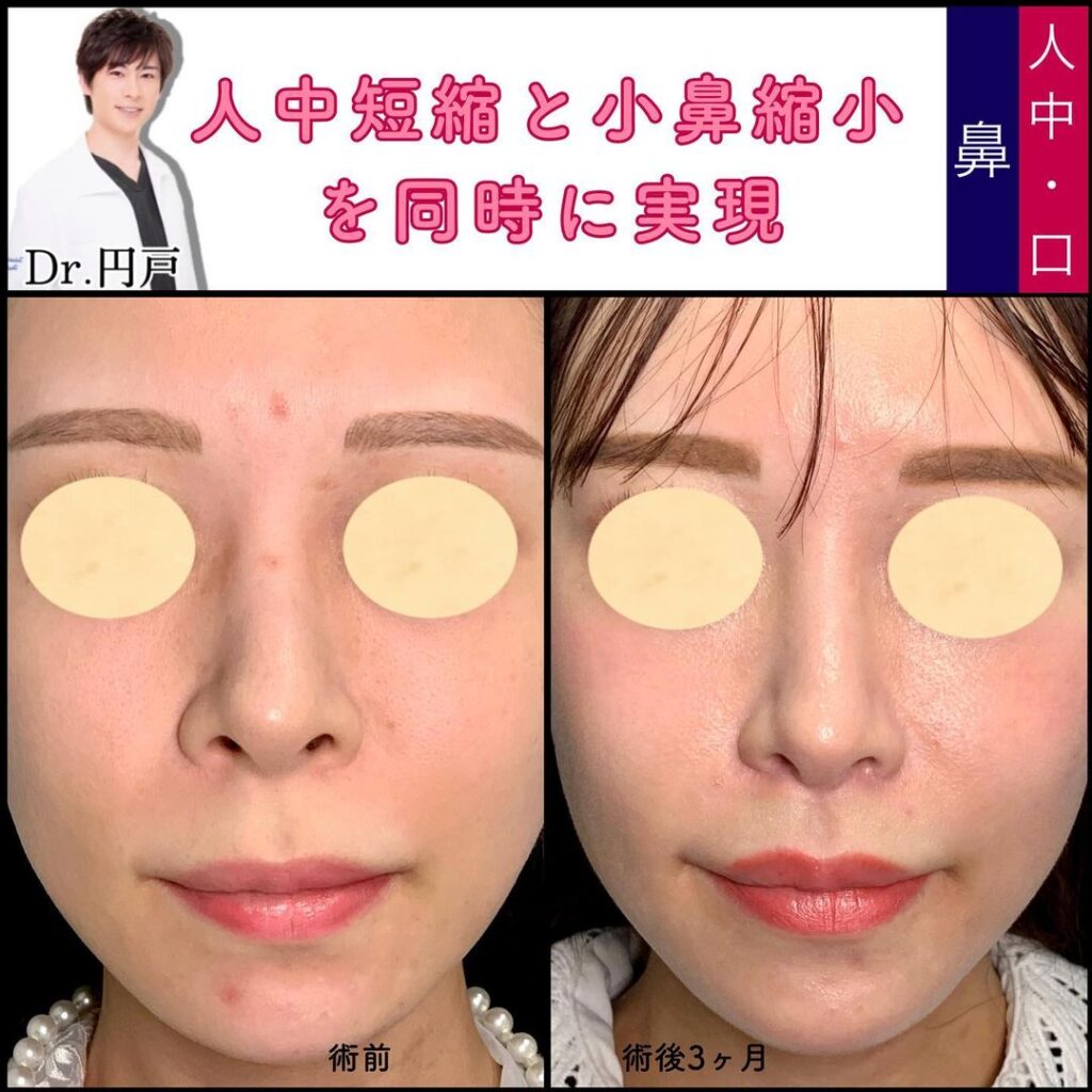 人中短縮と小鼻縮小の症例写真