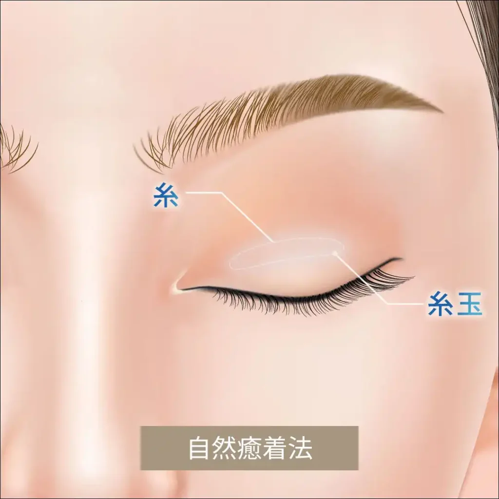 自然癒着法の図解