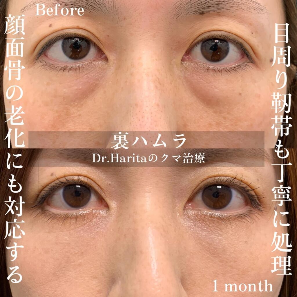 裏ハムラ法の症例写真 (3)