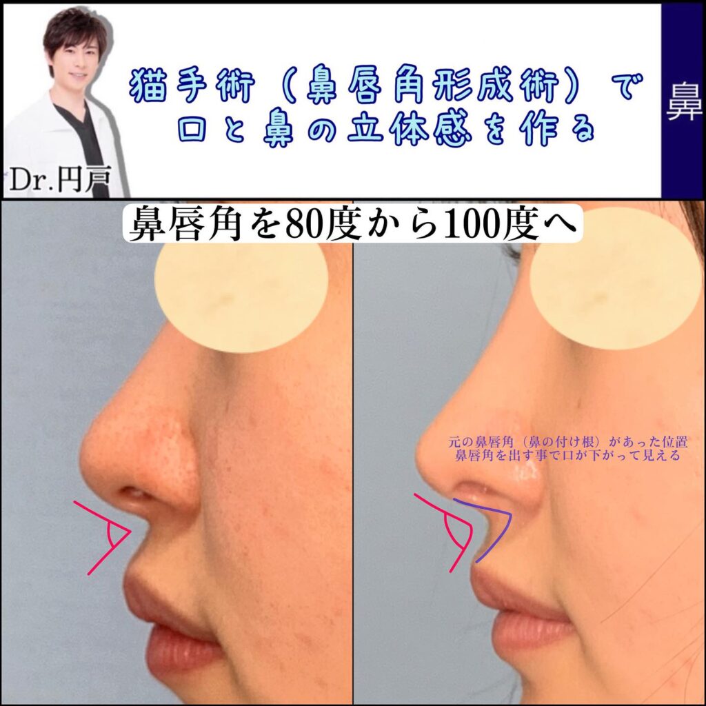 鼻唇角形成術（猫手術）併用した肋軟骨での鼻中隔延長の手術の3ヶ月後 (3)