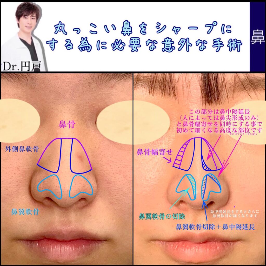 鼻尖形成と軟骨移植と鼻中隔延長に鼻翼上部の軟部組織除去と鼻孔縁軟骨移植を加えた症例