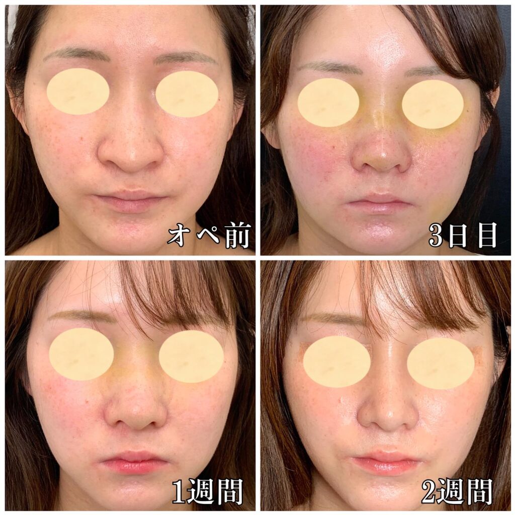 鼻骨骨切りと鼻尖形成の症例写真 (4)