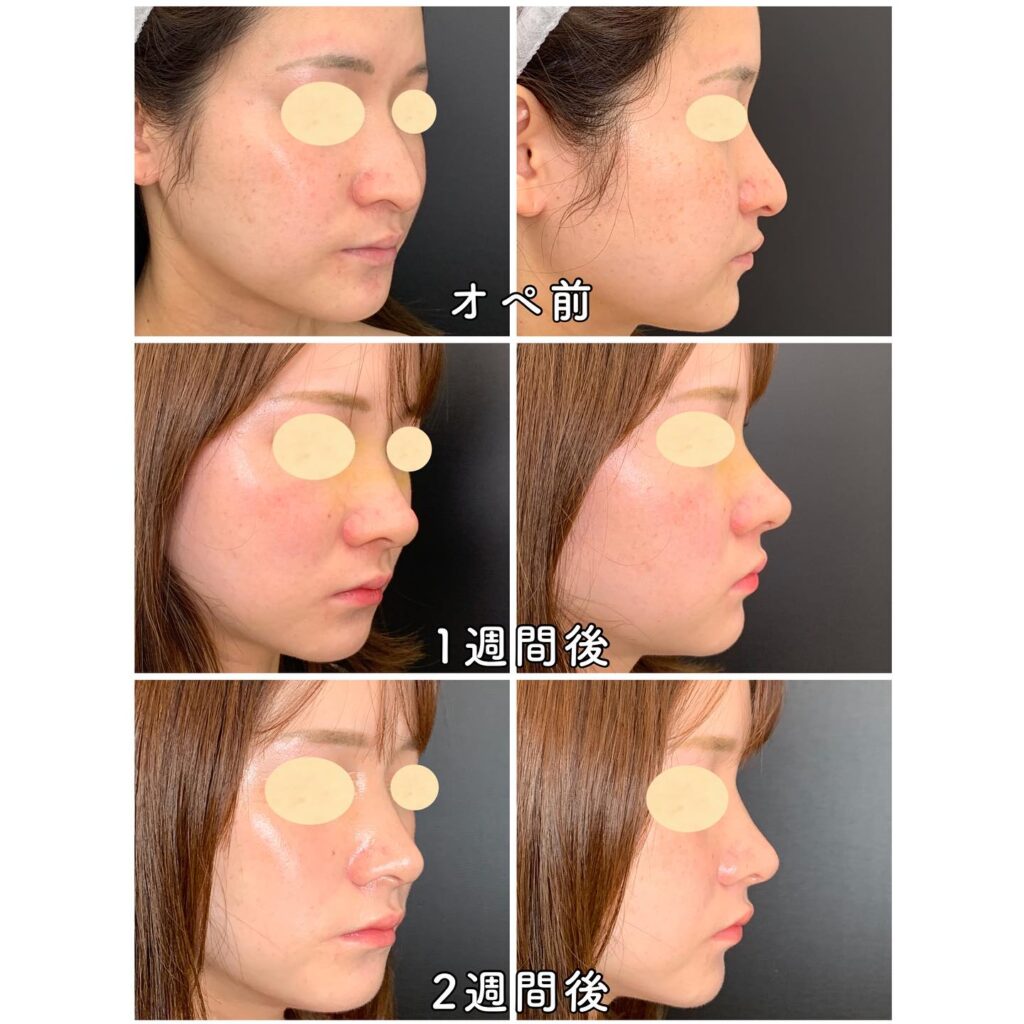 鼻骨骨切りと鼻尖形成の症例写真 (5)