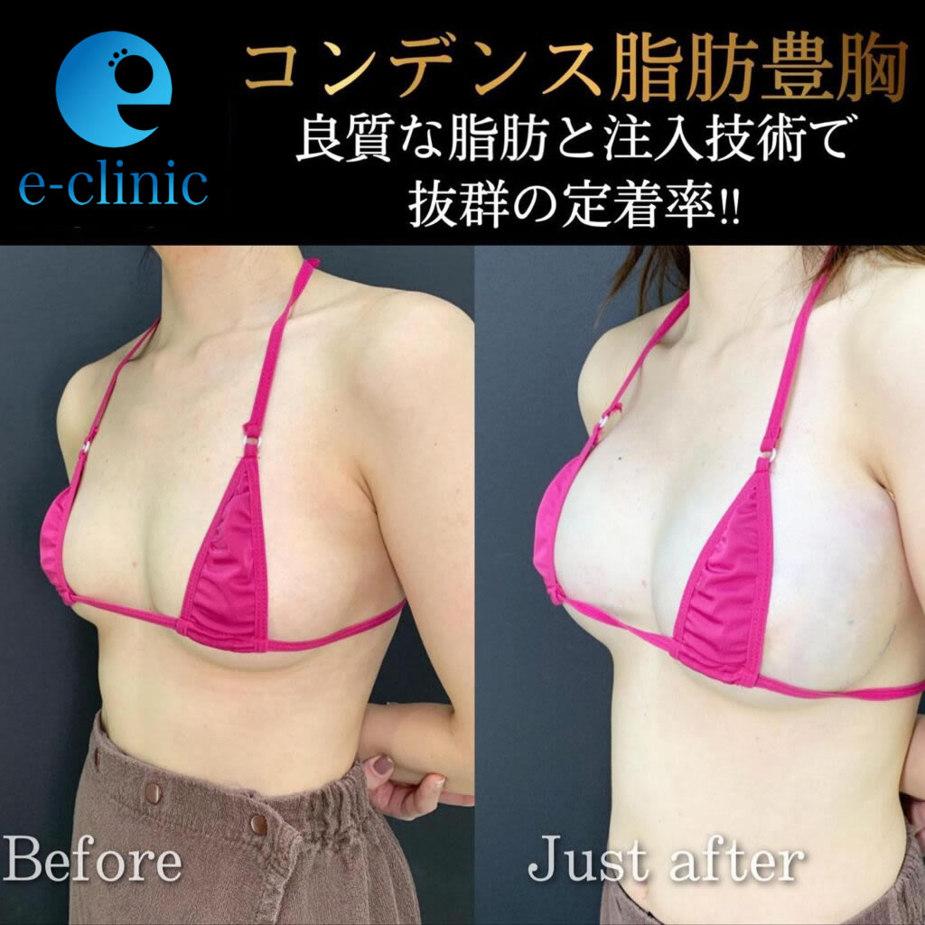 コンデンス脂肪豊胸 (60)