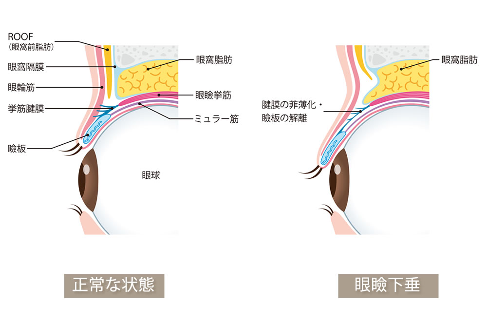 眼瞼下垂の図解