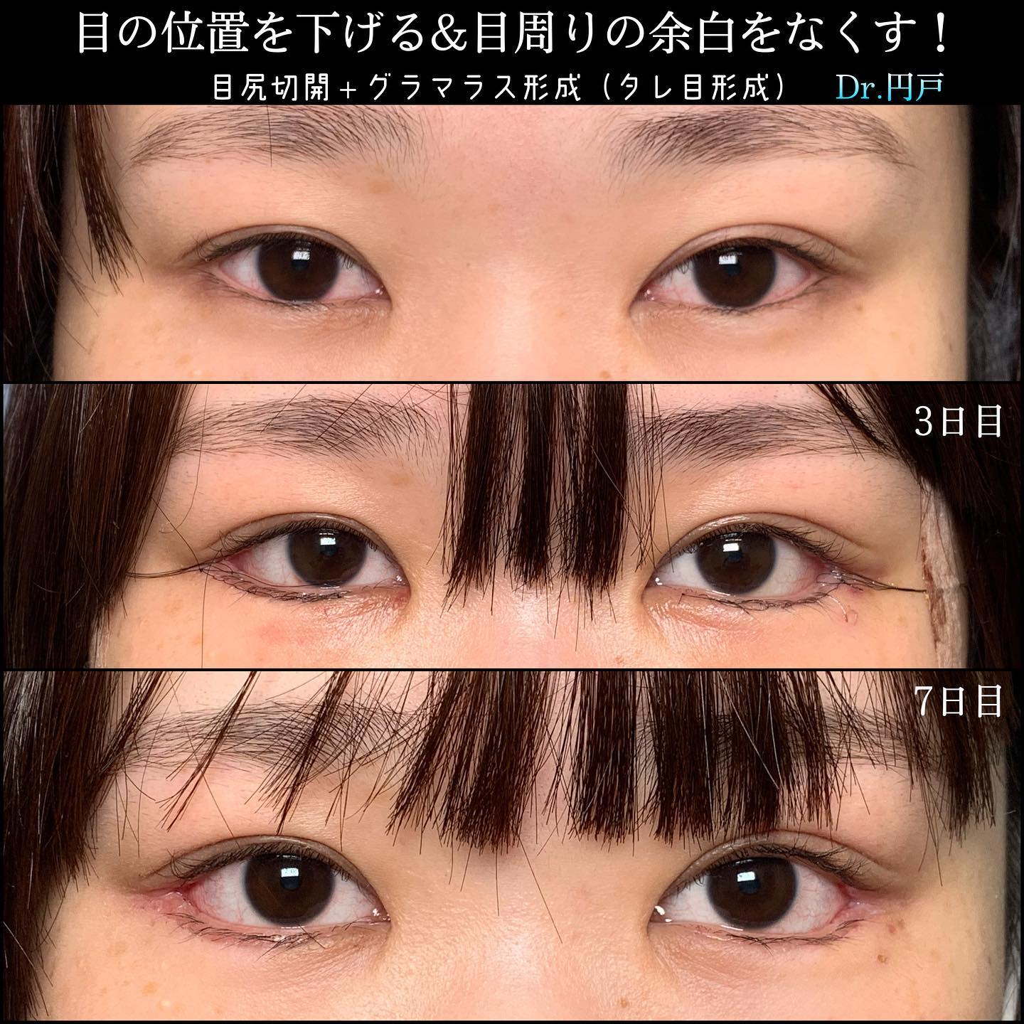 つり⽬感を残しつつ下瞼を広げるデザインの症例写真