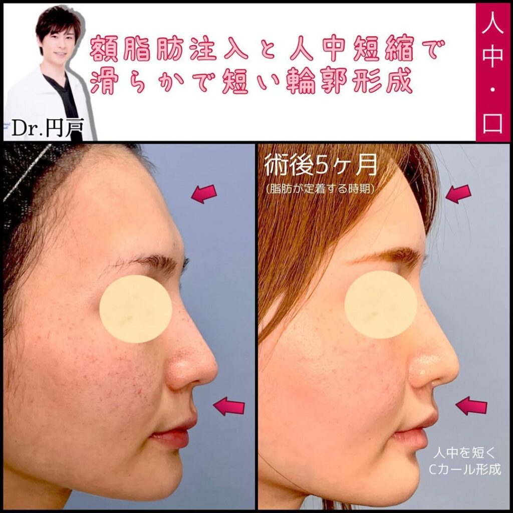 人中短縮、脂肪注入、糸リフト .顔の形は骨を切らなくても脂肪移植、脂肪吸引、糸リフトで整える事ができ、パーツの配置も人中短縮や目鼻整形で調整できます (1)