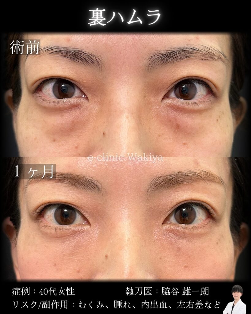 名医の脇谷雄一朗医師　裏ハムラ　クマ取り