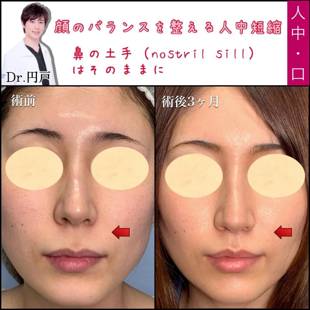円戸望医師の人中短縮の症例