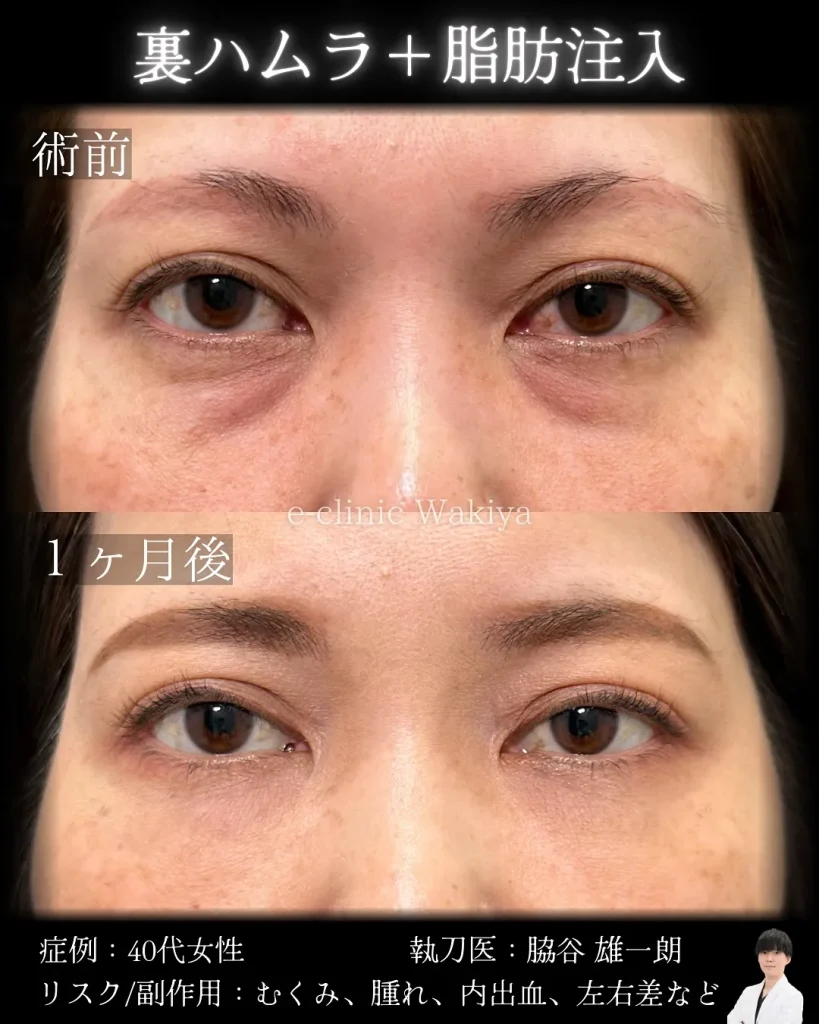 名医の脇谷雄一朗医師　裏ハムラ＋脂肪注入　クマ取り
