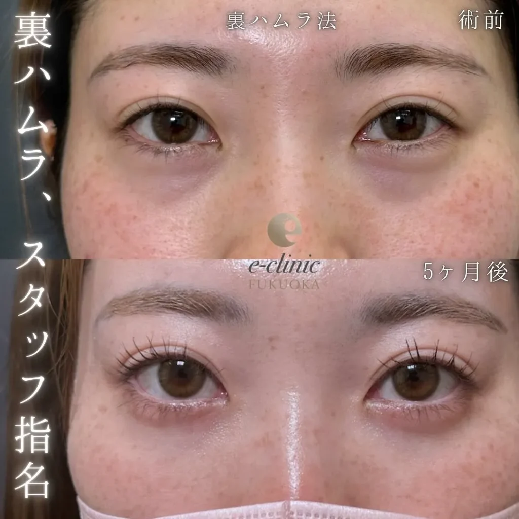 eクリニック福岡院のクマ取り裏ハムラ法（名医の伊藤渉医師が執刀）