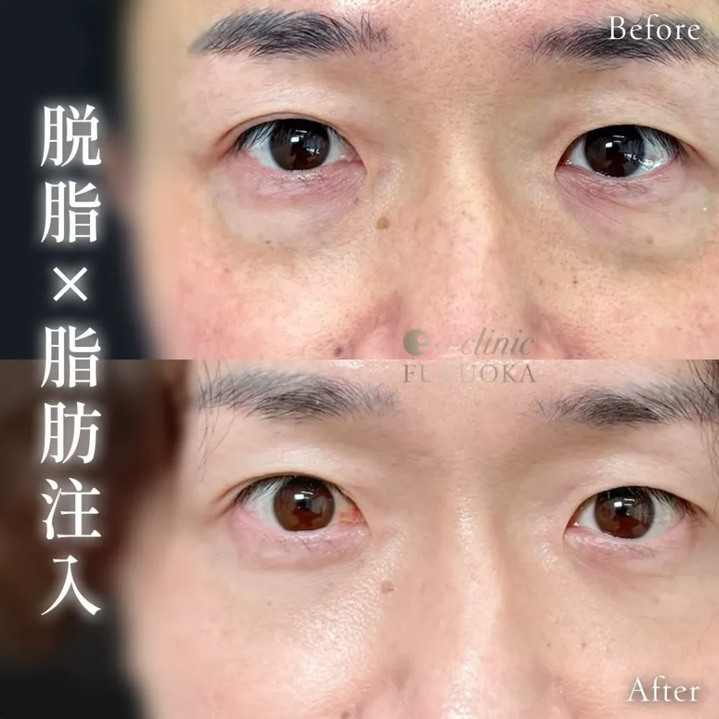 eクリニック福岡院のクマ取り脱脂＋脂肪注入（名医の伊藤渉医師が執刀）