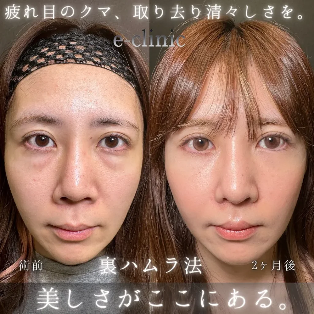 eクリニック福岡院のクマ取り裏ハムラ法（名医の伊藤渉医師が執刀）