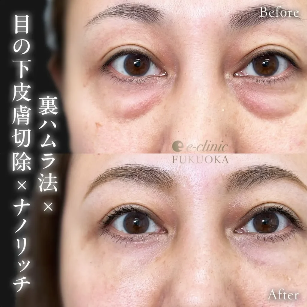 eクリニック福岡院のクマ取り裏ハムラ法＋目の下皮膚切除＋ナノリッチ脂肪注入（名医の伊藤渉医師が執刀）