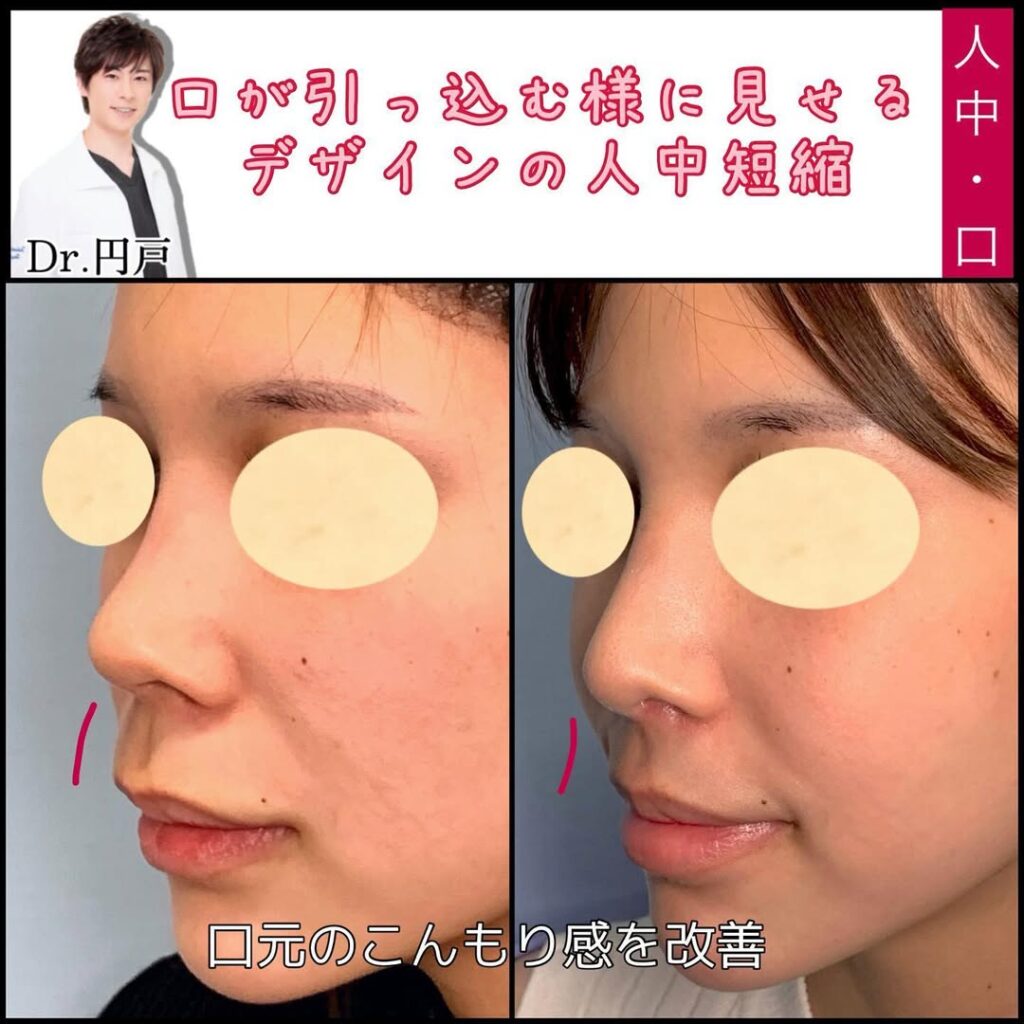 円戸望医師の人中短縮の症例