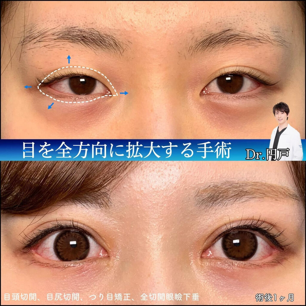 アーモンドアイ整形の症例