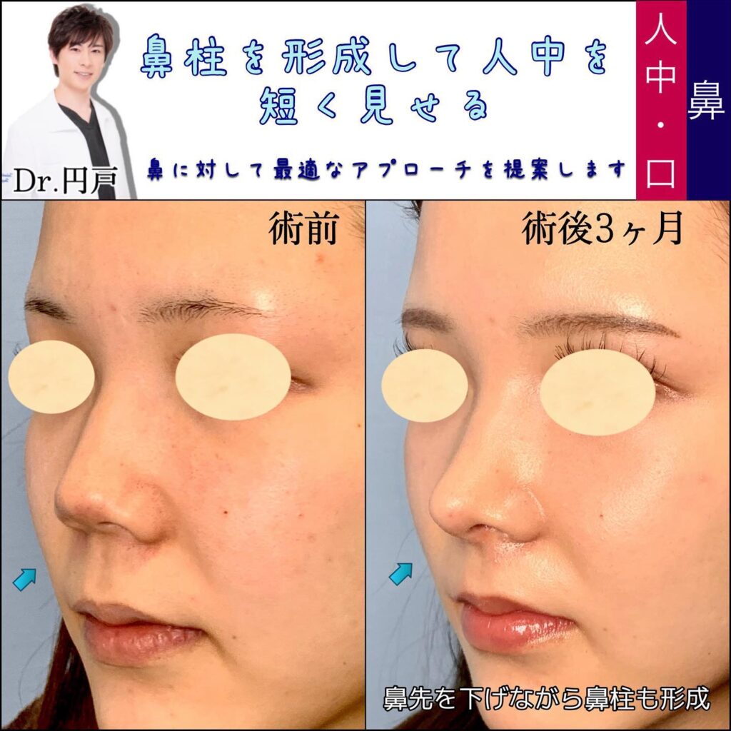 鼻柱下降の症例写真