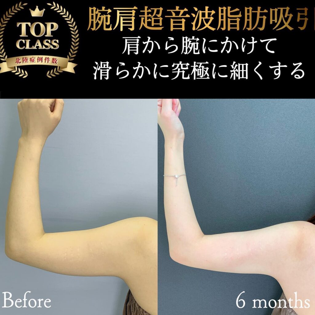 二の腕の脂肪吸引の症例写真