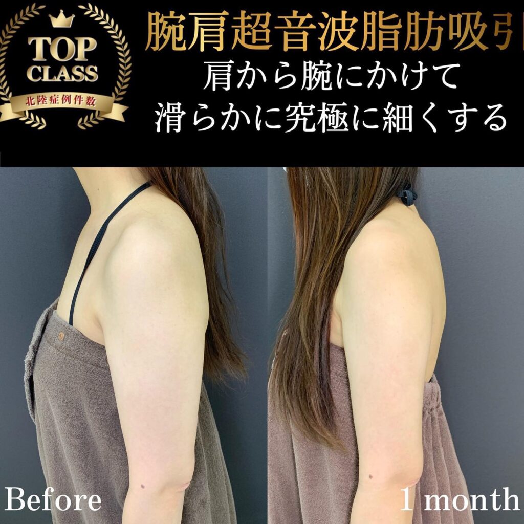 二の腕の脂肪吸引の症例写真