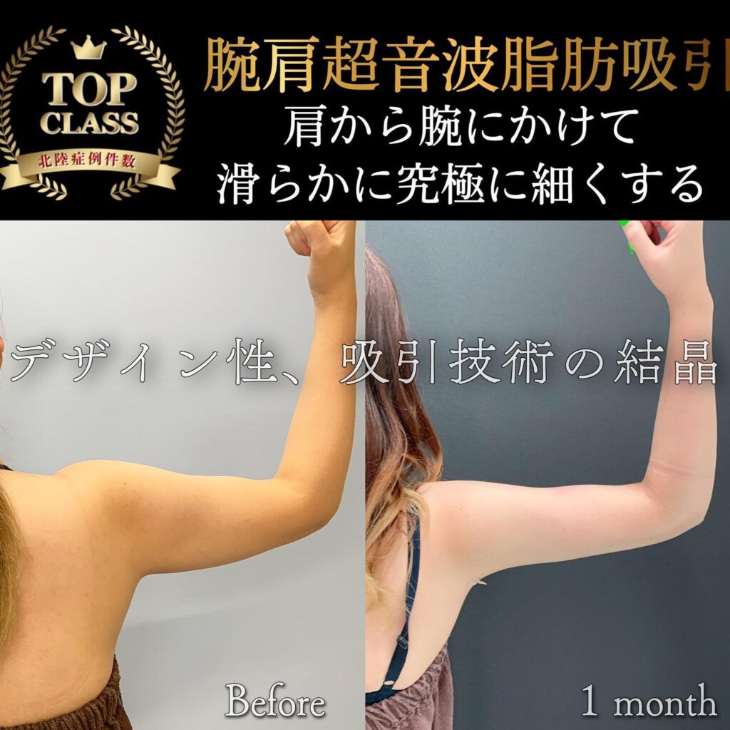 二の腕の脂肪吸引の症例写真 