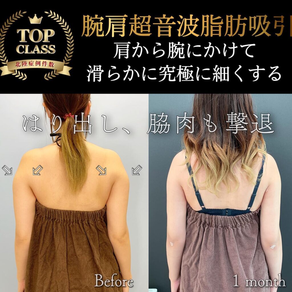 二の腕の脂肪吸引の症例写真
