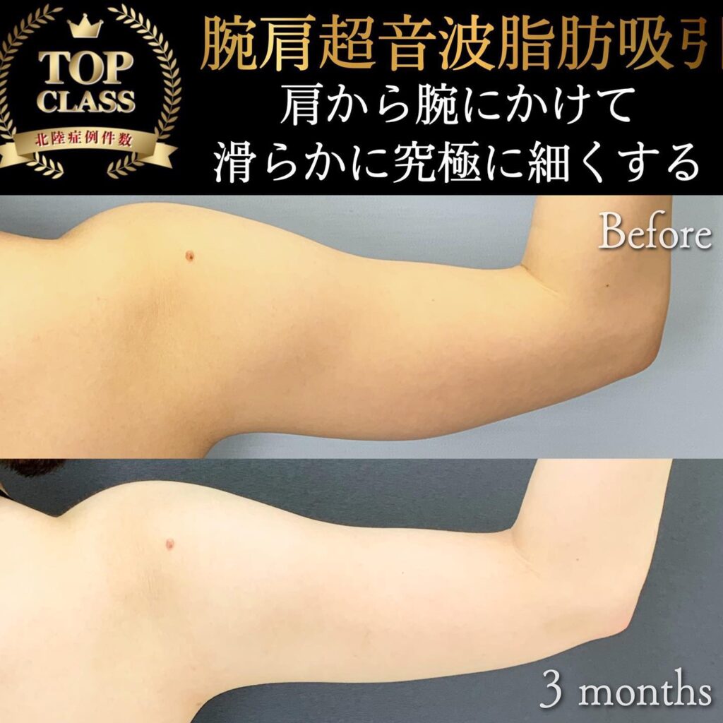 二の腕の脂肪吸引の症例写真