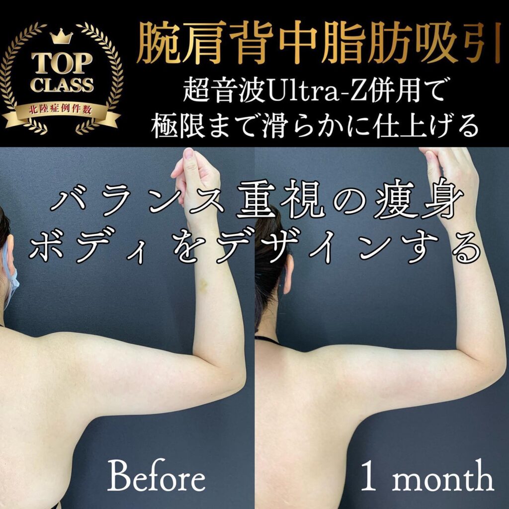 二の腕の脂肪吸引の症例写真