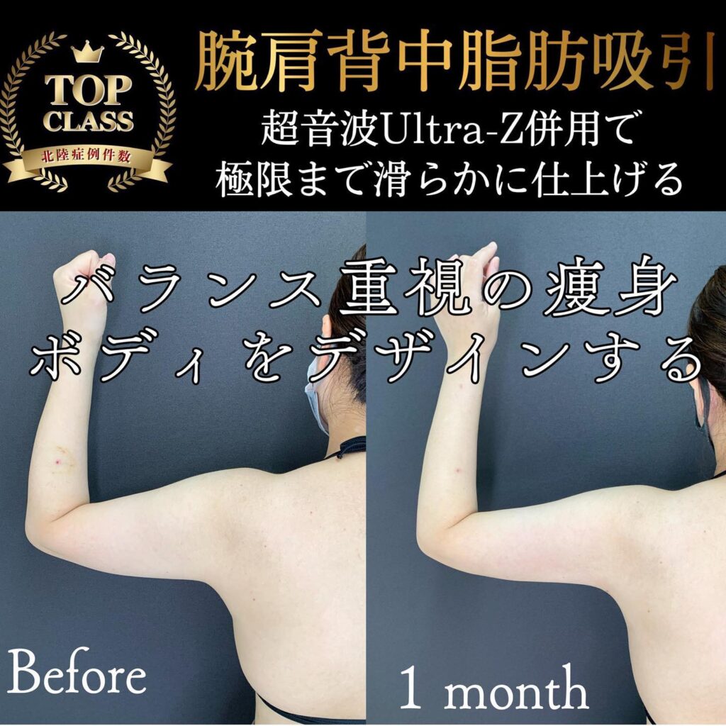 二の腕の脂肪吸引の症例写真
