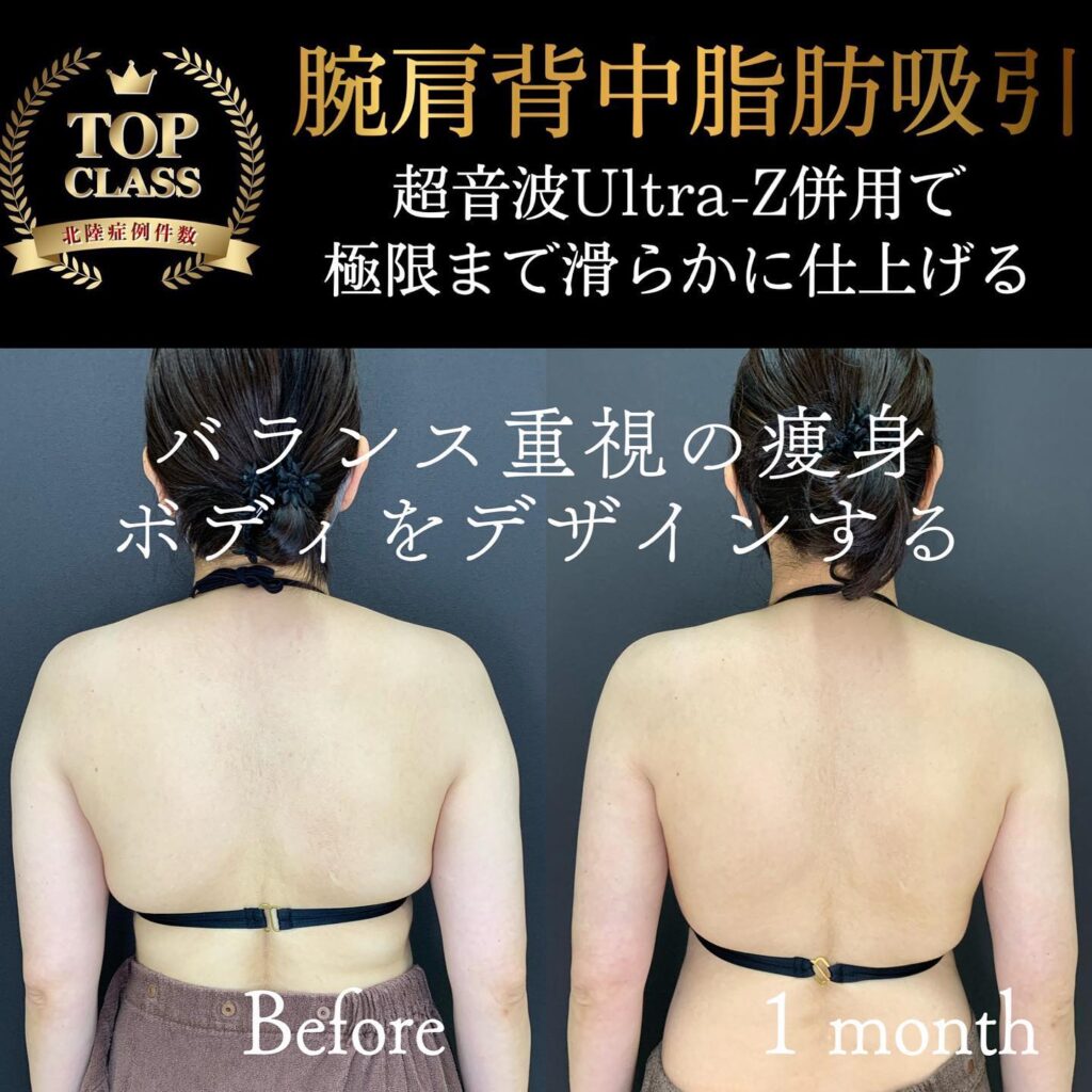 二の腕の脂肪吸引の症例写真