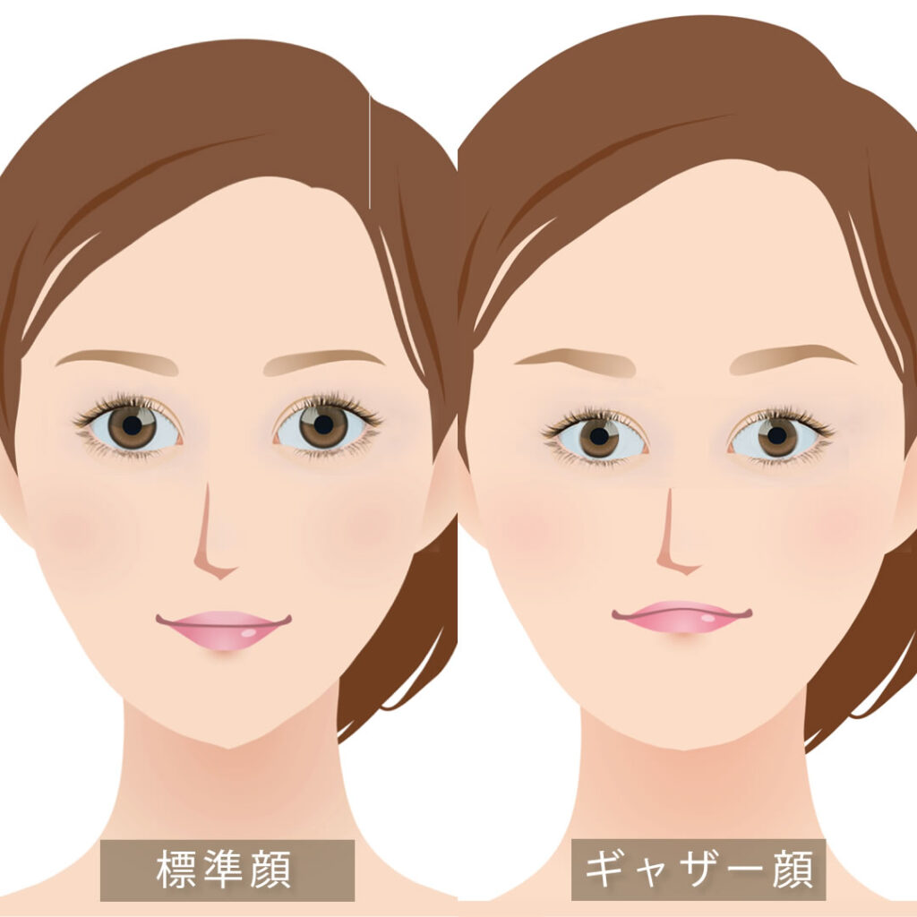 標準顔とギャザー顔の比較