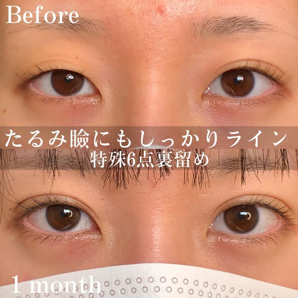 特殊6点留めの症例写真