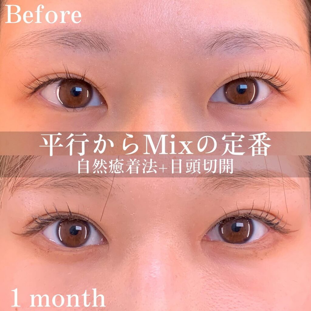 自然癒着法と目頭切開の症例写真 (6)