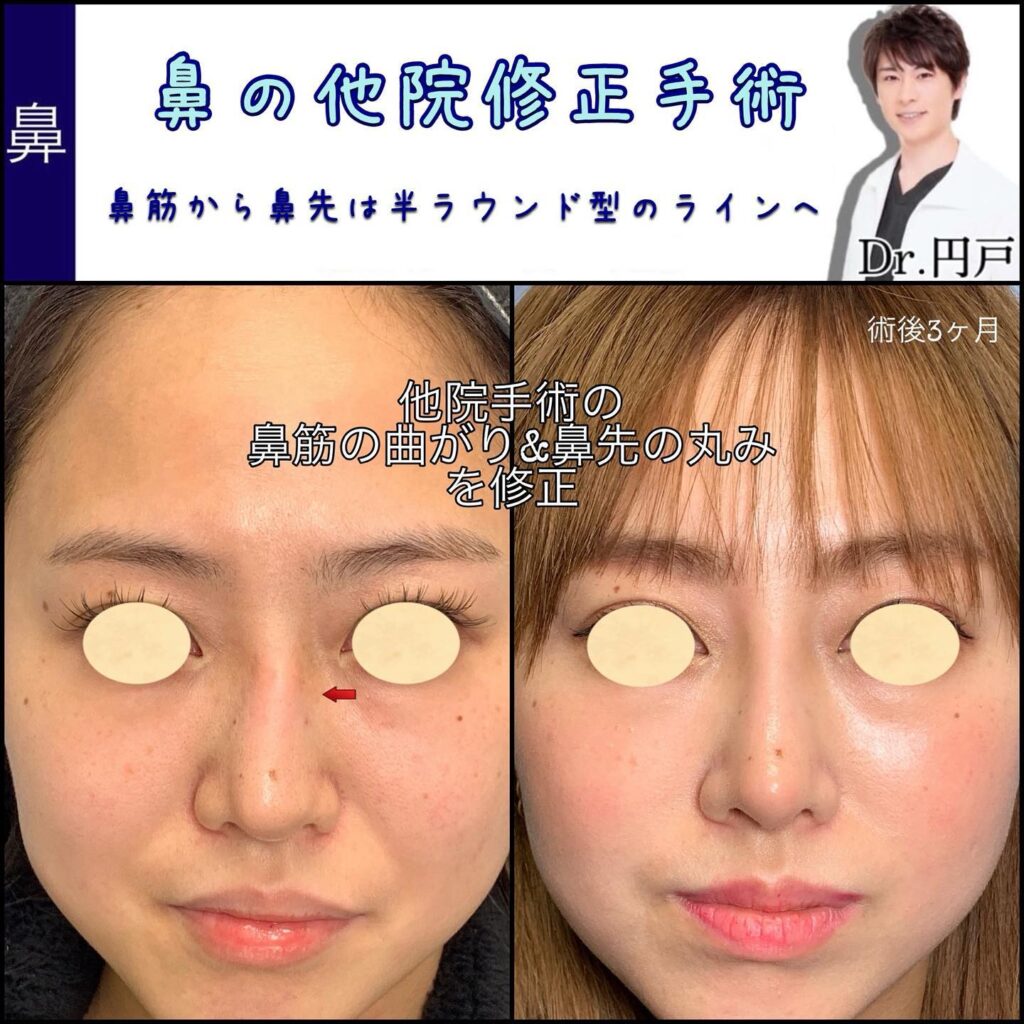 半ラウンド型の鼻を作った症例写真