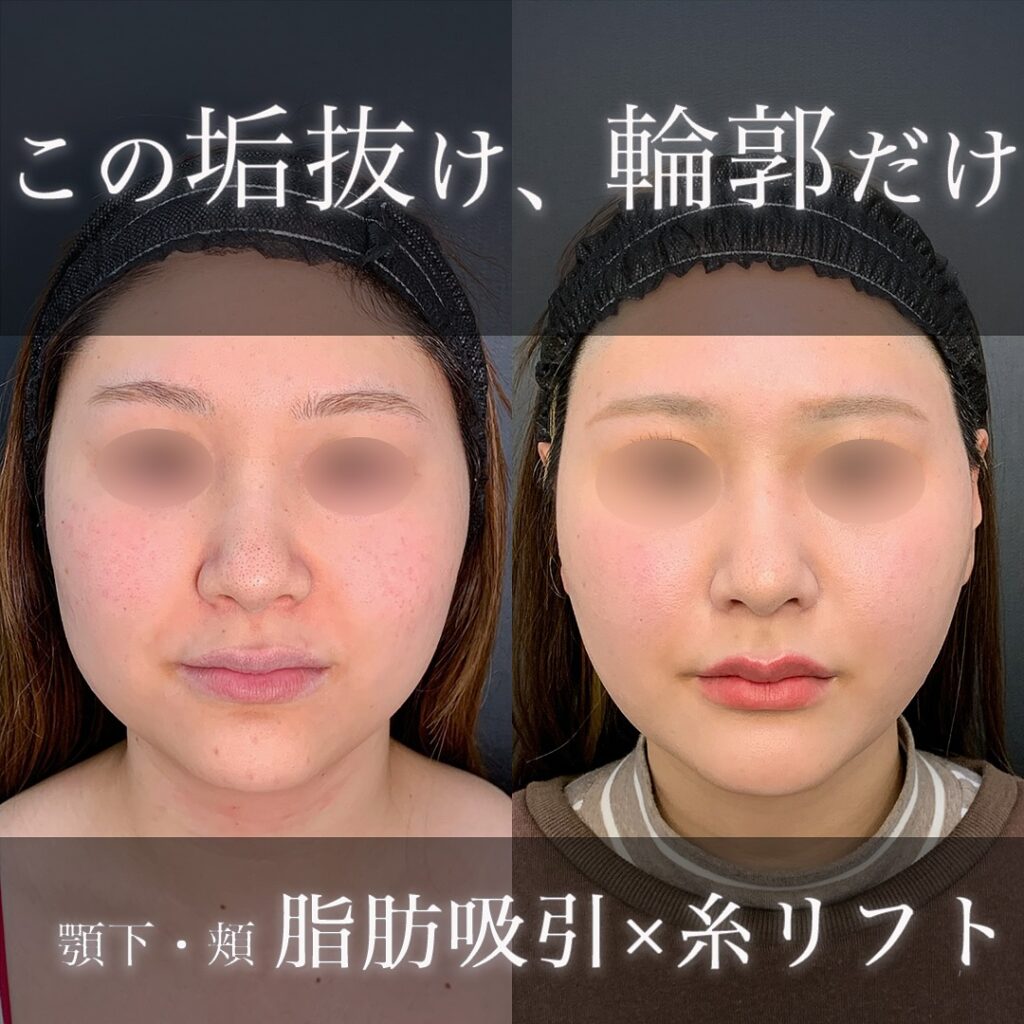 小顔の脂肪吸引と糸リフトの症例写真 (1)