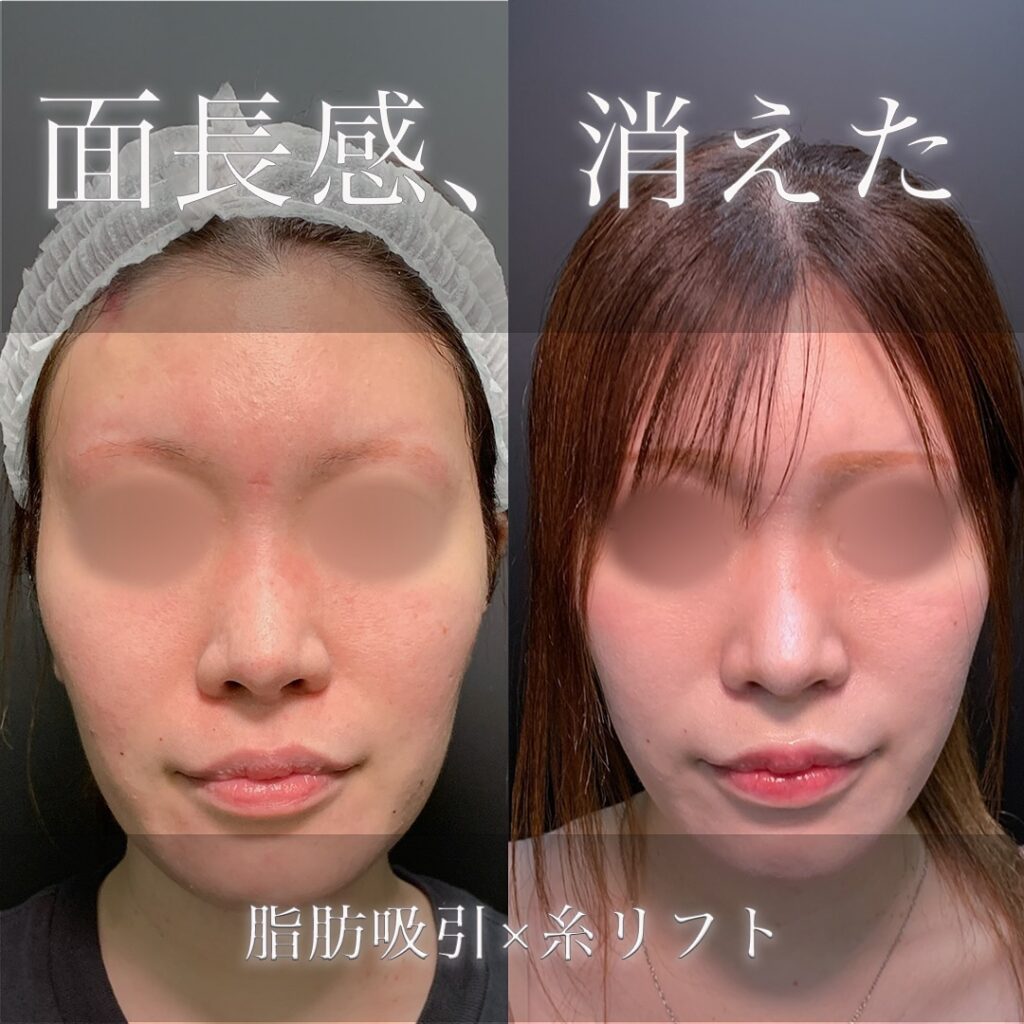 小顔脂肪吸引と糸リフトの症例写真