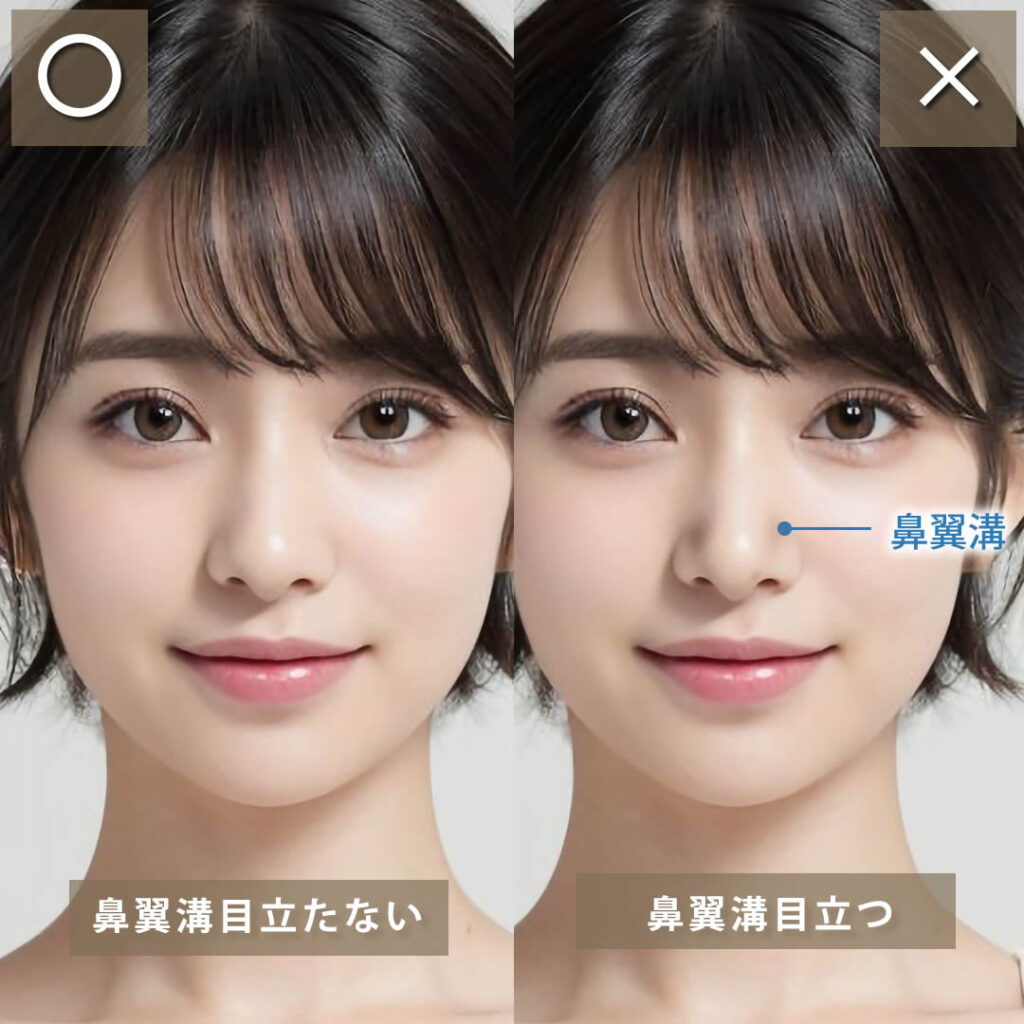 鼻翼溝の図解
