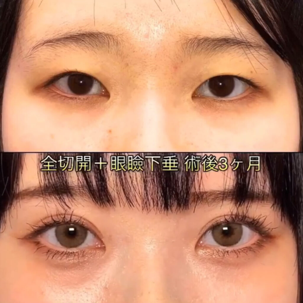 12 全切開と眼瞼下垂の３か月後の症例写真