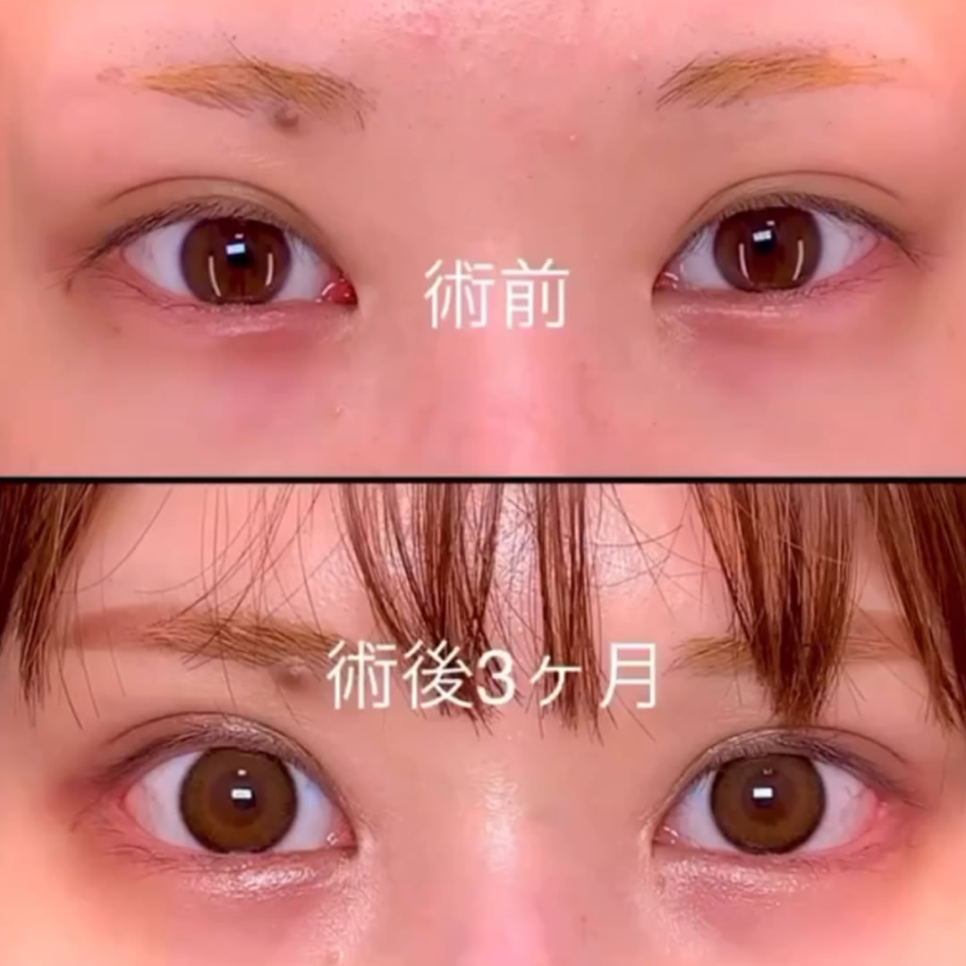 目尻切開とグラマラスライン形成と他院修正の術後１か月後の症例写真