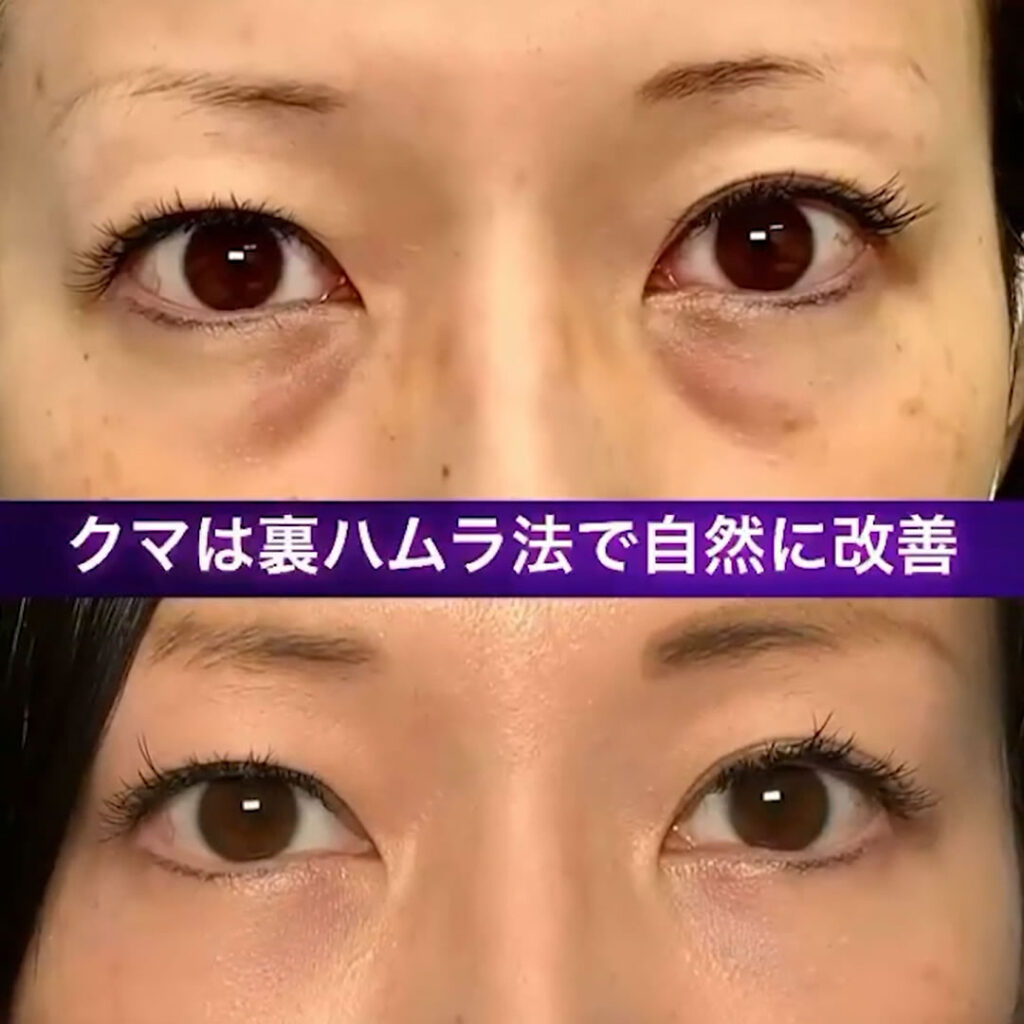 裏ハムラで自然に改善した症例