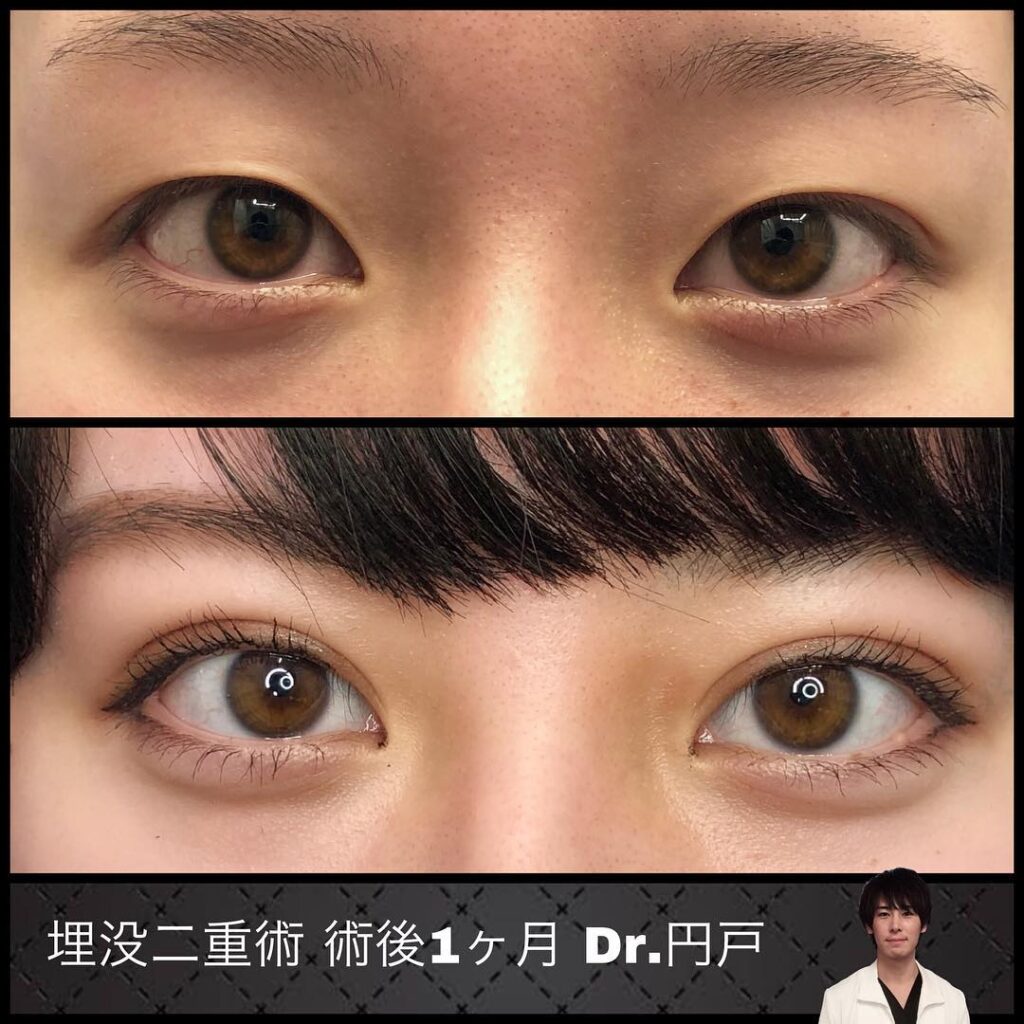 埋没法の術後１か月