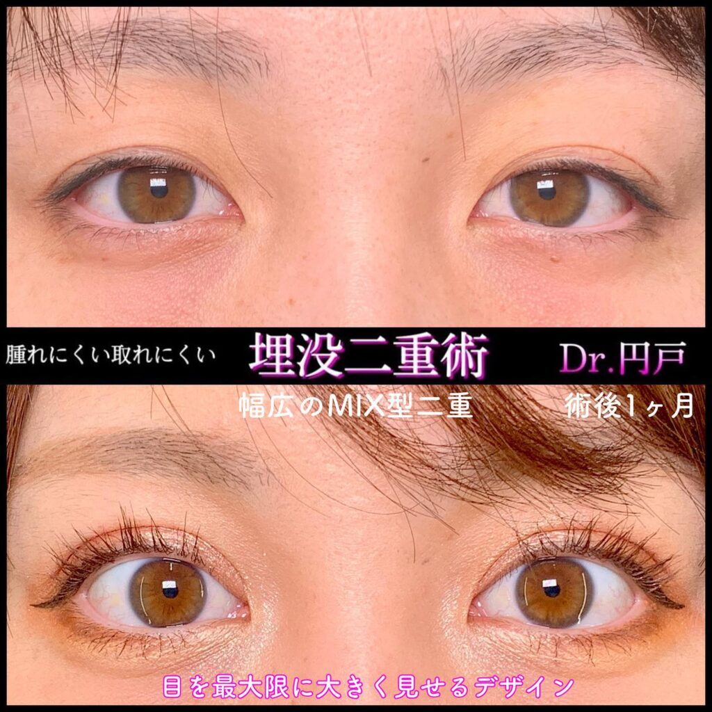埋没法の術後１か月の症例写真