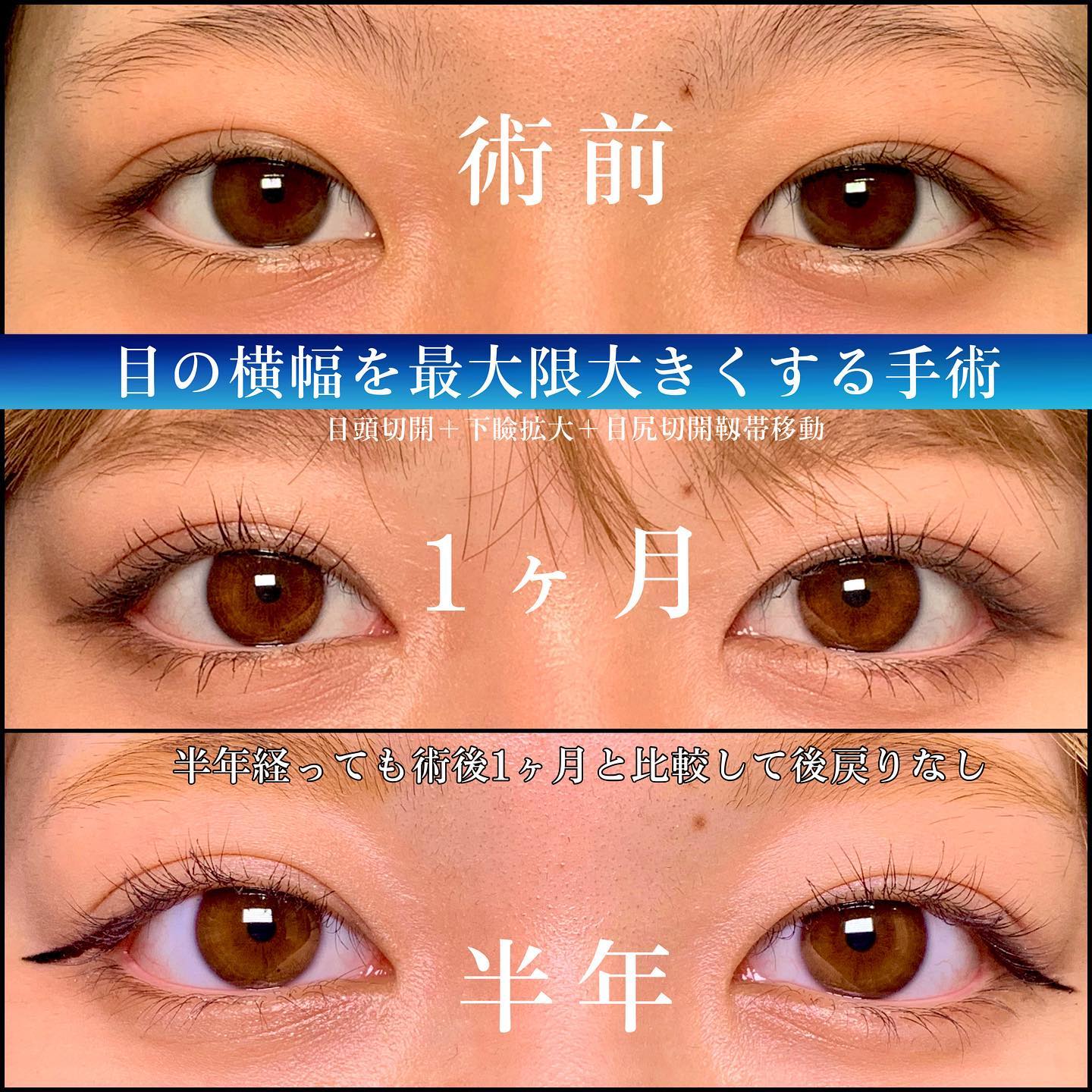 目頭切開と下瞼拡大と目尻切開と目尻靭帯移動の症例写真