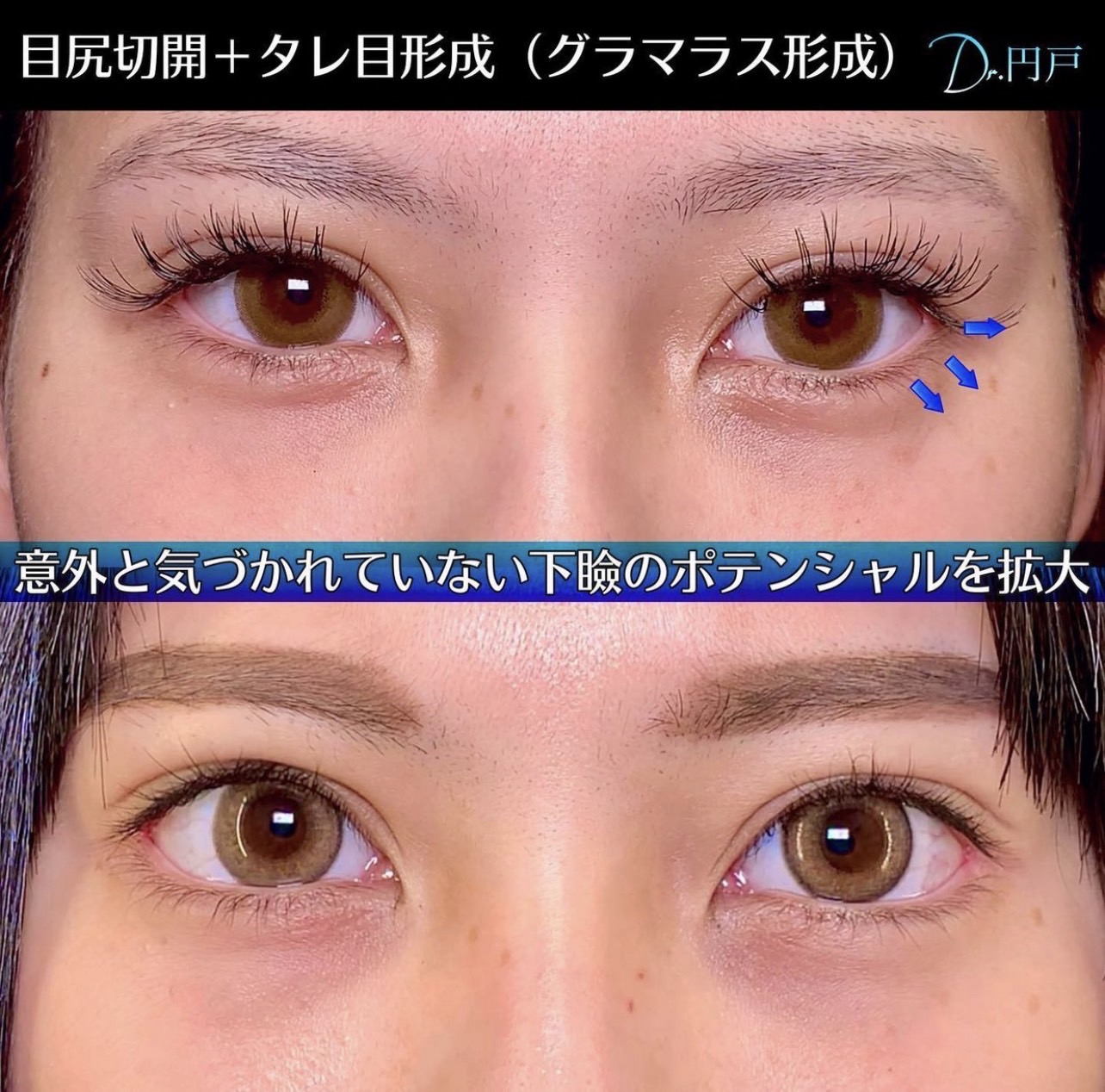 目尻切開とタレ目形成の症例