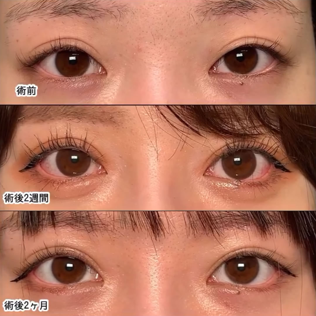 目上切開と下瞼拡大と目尻靭帯移動の症例写真