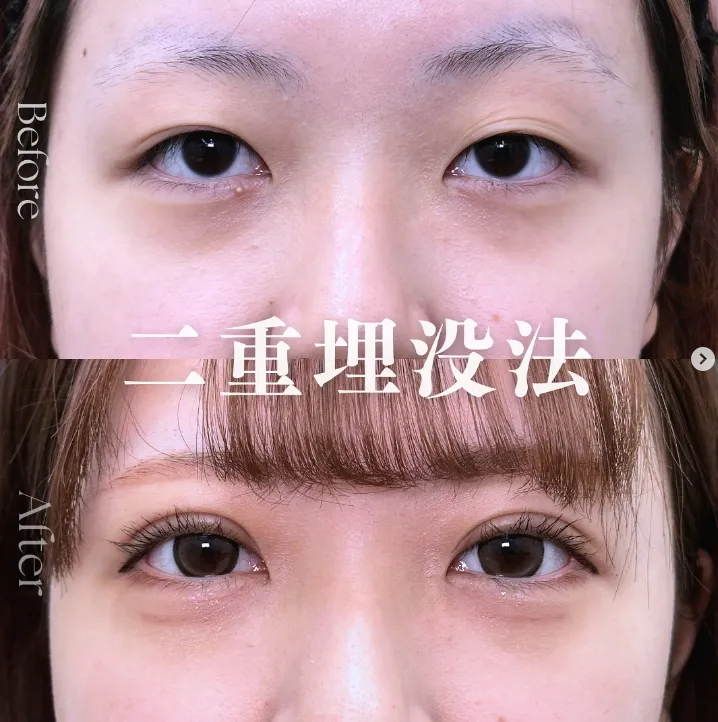 二重埋没法 岡山 名医