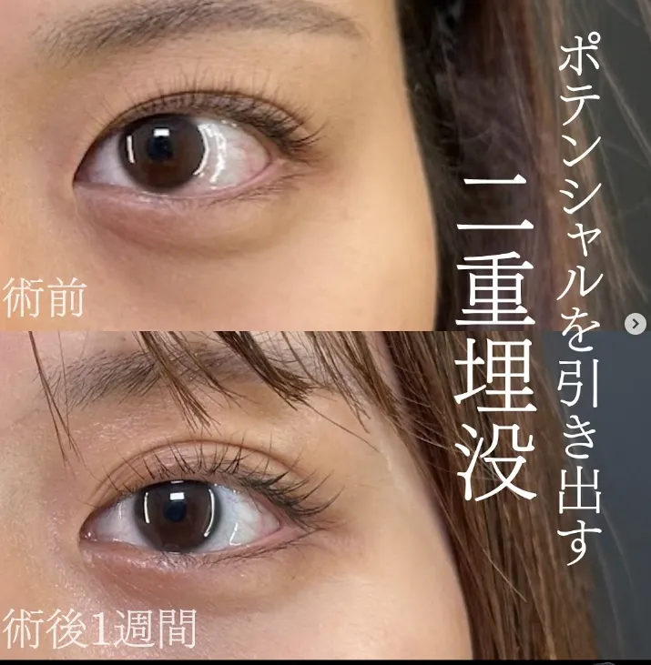 二重埋没法 岡山 名医2