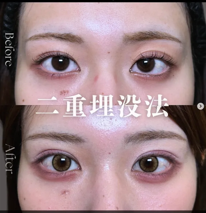 二重埋没法 岡山 名医3