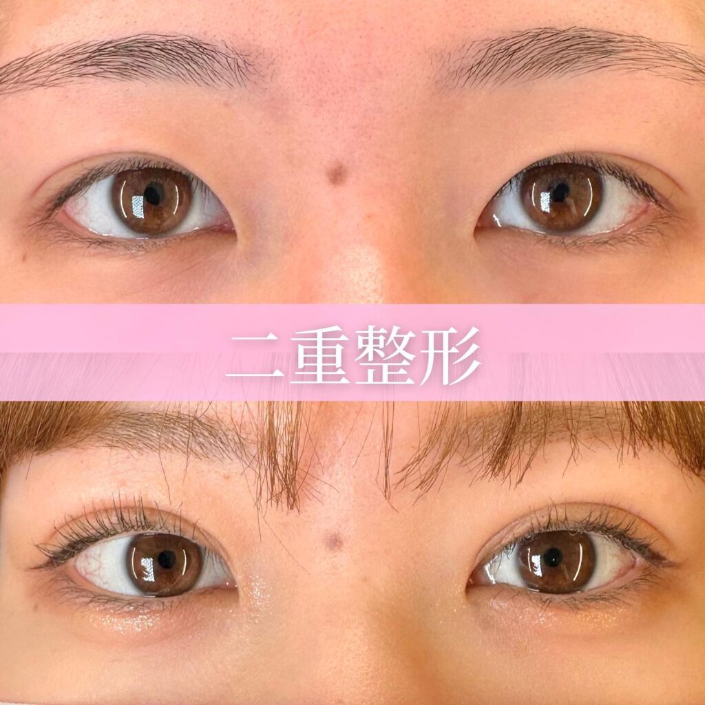 埋没法 クイックループダブル4点裏留めの症例写真 (2)