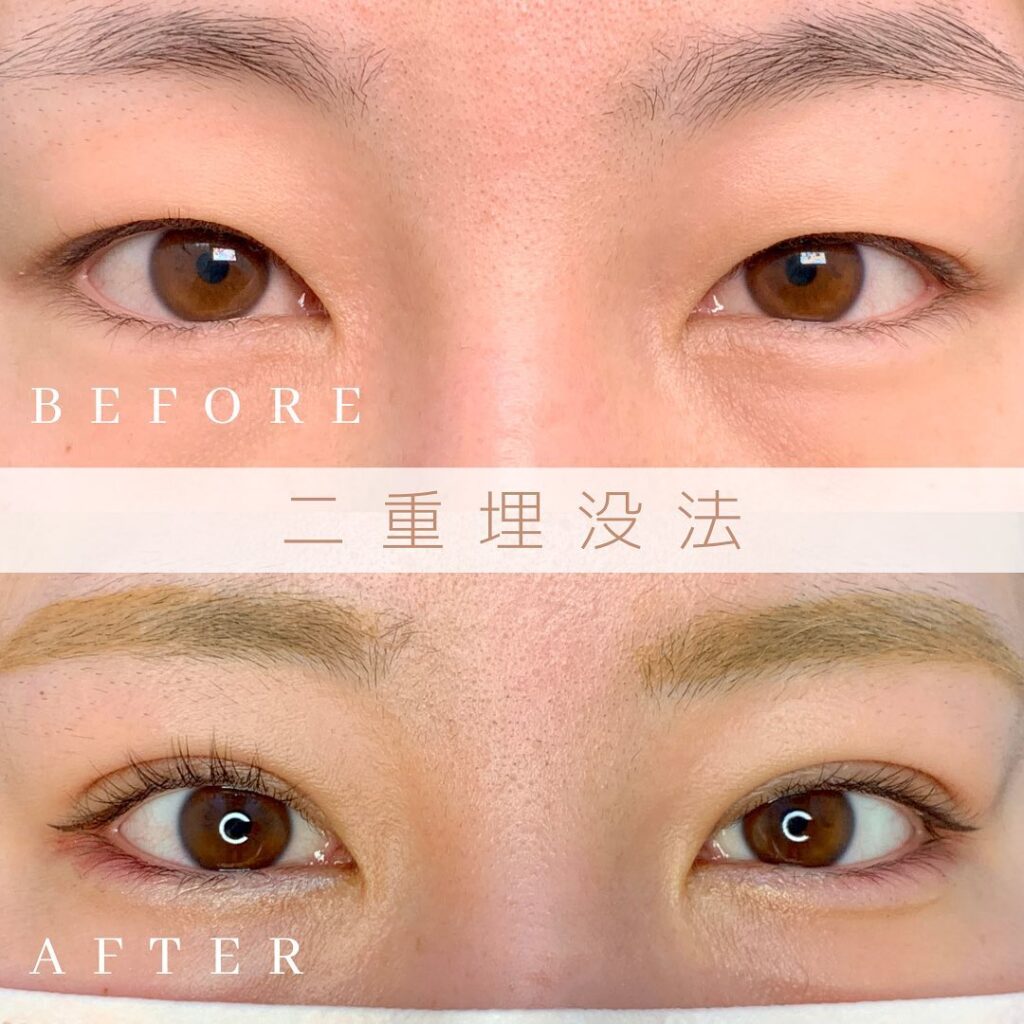 埋没法の症例写真 (11)