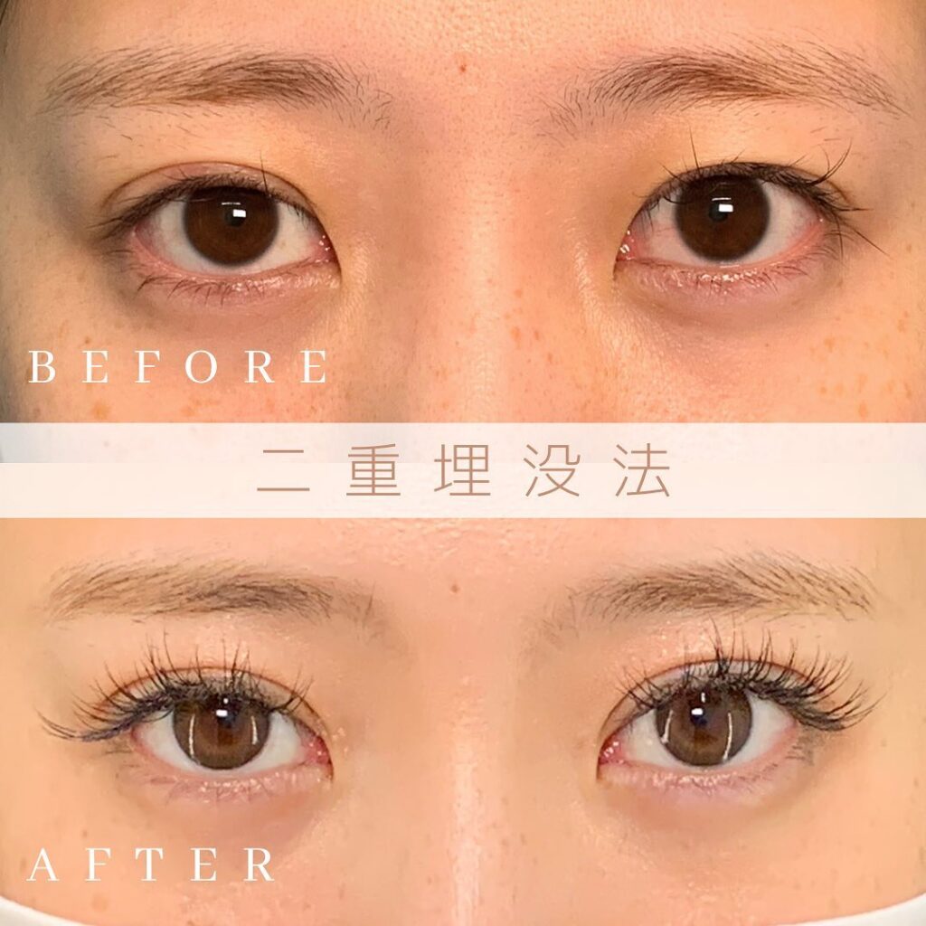 埋没法の症例写真 (12)